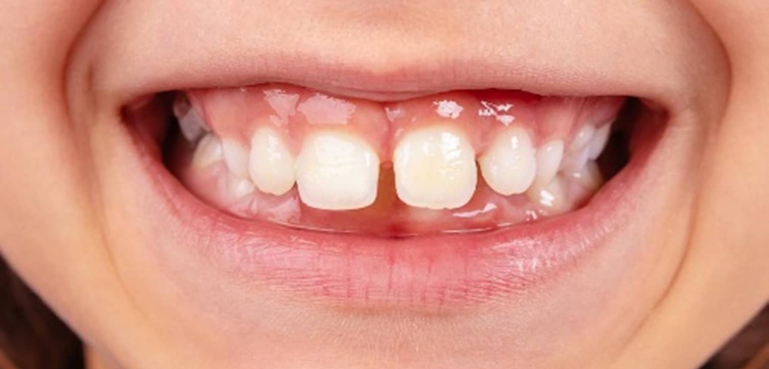 Crooked teeth need to be fixed with orthodontic treatment